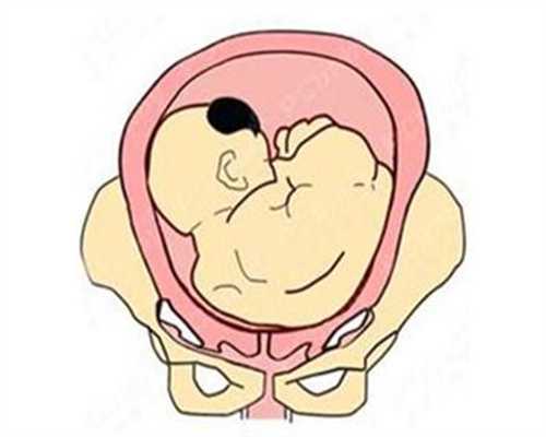 绍兴代孕有什么风险:什么是胎盘低置-